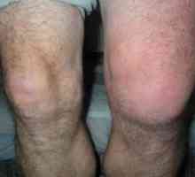 De ce am și ceea ce boala este însoțită de umflarea articulației genunchiului