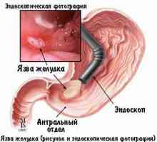 Simptomele de sângerare ulcer gastric