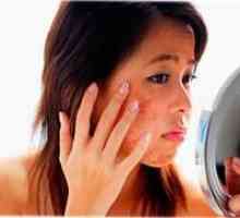 Teenage acnee - cum de a vindeca acneea vulgară?