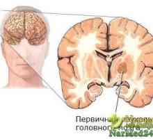 Remedii populare Improvizate pentru tratamentul tumorilor cerebrale