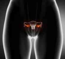 Ovare polichistice: principalele simptome si cauze