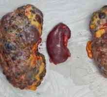 Ce este boala de rinichi polichistic? Există modalități de recuperare