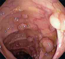 Polipii în intestin datorită inflamație a pereților tractului gastrointestinal