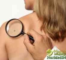 Prevenirea pielii carcinom cu celule bazale metodele traditionale