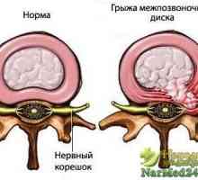 Prevenirea metodelor traditionale hernia intervertebral
