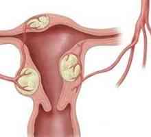 Boli ginecologice in timpul menopauzei
