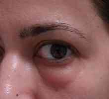 Cauzele și tratamentul ochii umflati