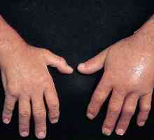 Cauzele și tratamentul edemelor mână