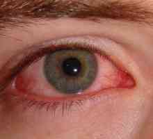 Cauzele și tratamentul edem alergic ochi