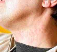 Cauzele de acnee pe gât și metode eficiente de tratament