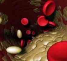 Cauzele nivel ridicat de colesterol în sânge - ambele trebuie să fie tratate? remedii populare sunt…