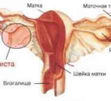 Cauze, simptome și tratament de chisturi in uter