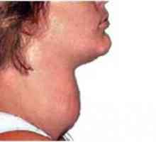 Cauze, simptome si tratamentul hipertiroidismului la femei