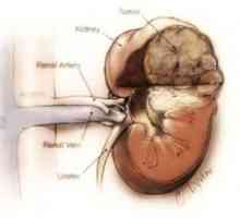 Cauzele sigiliu în rinichi: un diagnostic probabil
