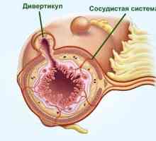 Cauzele diverticul intestinal