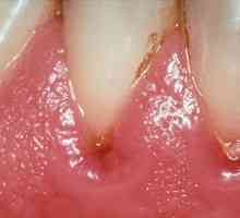 Cauzele si tratamentul abceselor guma