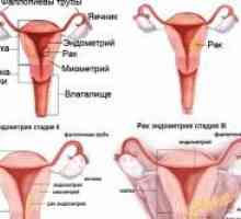 Cauzele și tratamentul hiperplaziei endometriale a uterului