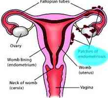 Cauzele endometriozei, uterin - ia în considerare toate teoriile