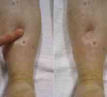 Cauzele și tratamentul pentru umflarea picioarelor