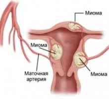 Utilizarea acidului folic în miomul uterin