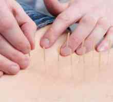 Utilizarea de acupunctura pentru hernie spinarii