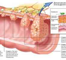 Semne, prognosticul și tratamentul cancerului duodenal