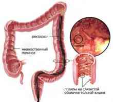 Ce metode de a elimina polipi in intestine?