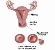 Realizarea procedurii de biopsie de col uterin