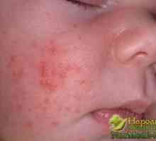 Remediu popular dovedita pentru acnee
