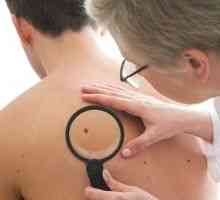 Cancerul de piele: primele semne. Specii de variație.