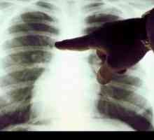 Cancer pulmonar