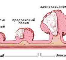 Prognosticul cancerului de colon a patra etapă