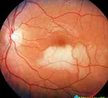 Stratificarea a retinei ochilor: cauze și consecințe