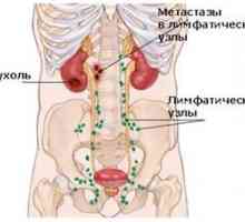 Varietatea și tratamentul adenopatiei abdominale