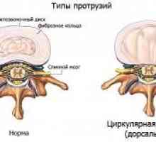 Soiurile proeminenței lumbosacrale coloanei vertebrale. Simptome si tratament.
