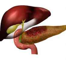 Simptome și tratament de pancreatită alcoolică