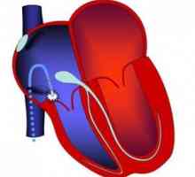 RF ablatia a inimii: caracteristici, preparare, tratare, recuperare