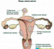 Reabilitarea după îndepărtarea fibrom uterin