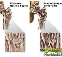 Incluse în medicina populară în tratamentul osteoporozei
