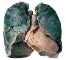 Sarcoidoza pulmonară