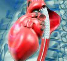 Anevrism inima: cauze, simptome, cum să trateze