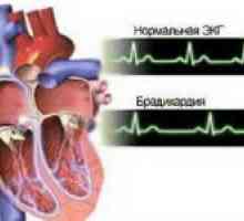 Bradicardie cardiace: Ce fel de boală și cum este periculos?