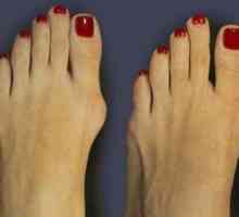 Denivelările pe degetele de la picioare: tratamentul de atac folk