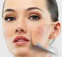 Cicatricile de la acnee. Cum să eliminați?