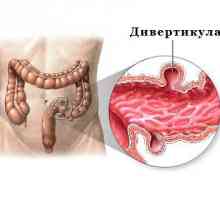 Simptomatologia și tratamentul diverticulitei de colon sigmoid