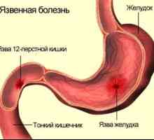 Care sunt simptomele de ulcer duodenal bec?