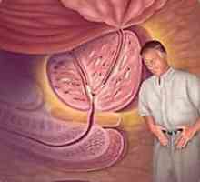 Simptomele hiperplaziei benigne de prostată