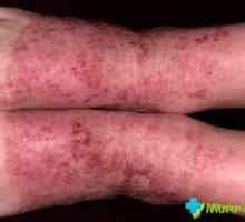 Simptomele dermatitei în fotografie. tipuri de dermatita