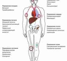 Simptome, diagnostic și tratament al bolii Crohn