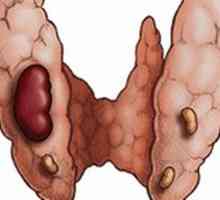Simptomele si tratamentul adenomului tiroidian